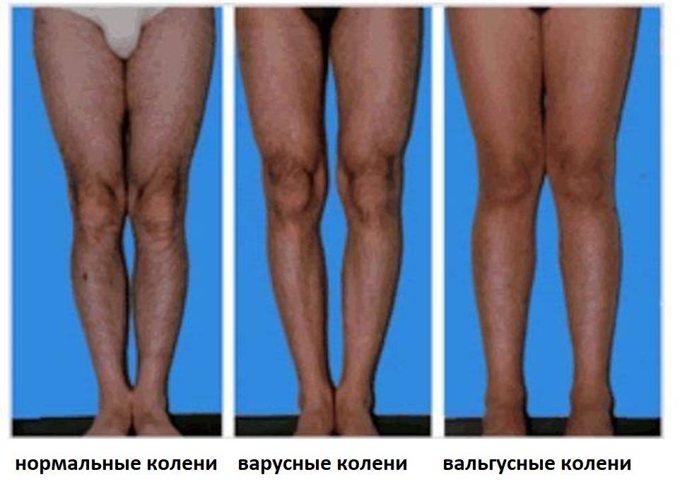 Valgusknie, Valgusknie und normale Knie