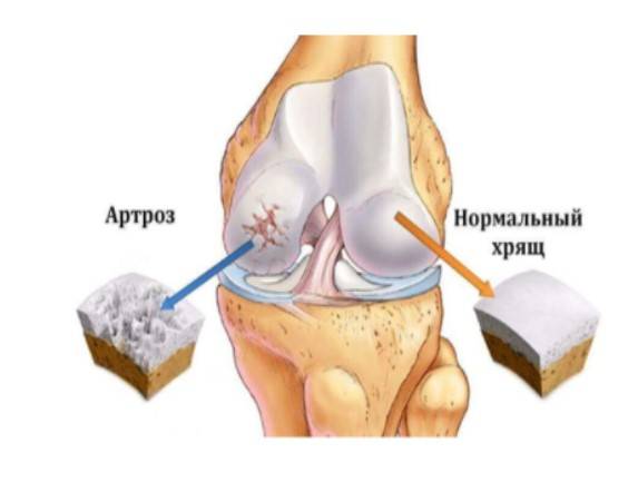 Behandlung der Arthrose des Kniegelenks