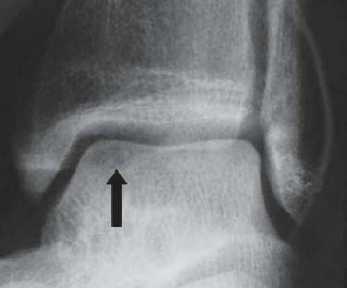 Röntgenbild eines Knorpeldefekts im Thalamus