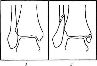 Abb. 1: Schematische Darstellung einer anterioren Röntgenaufnahme des Sprunggelenks: 1 - normal (zum Vergleich); 2 - bei Dupuytren-Fraktur (Wadenbein- und Innenknöchelbrüche, Riss der unteren intertrochantären Syndesmose).