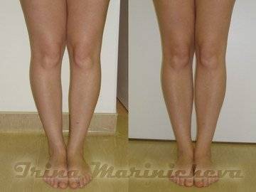 Crookplasty - Fotos vor und nach der Operation