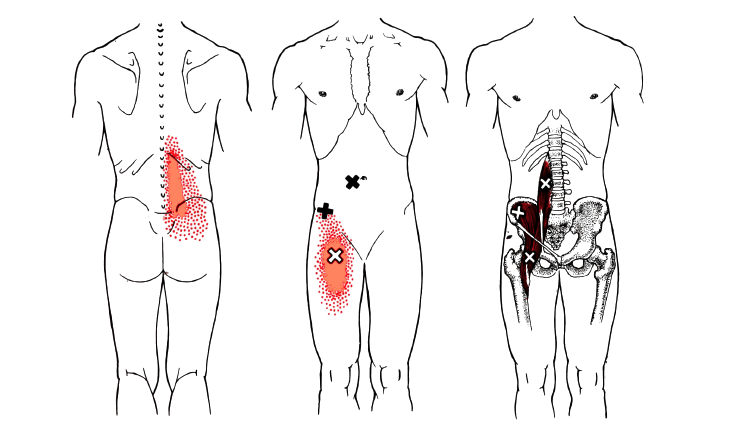 Myofasziales Iliopsoas-Syndrom