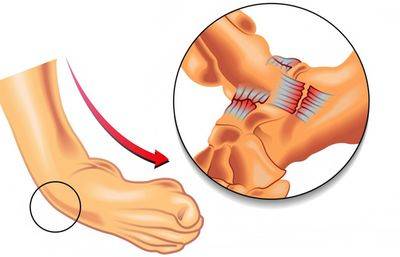 Sprains and strains of the foot