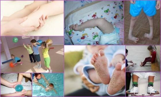 Clubfoot exercises in a child - implementation