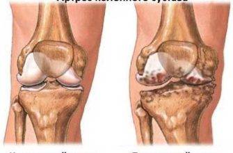 Osteoarthritis des Knies