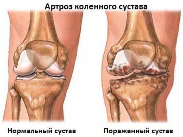 Osteoarthritis des Knies