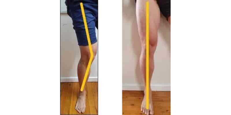 mobilization of the knee