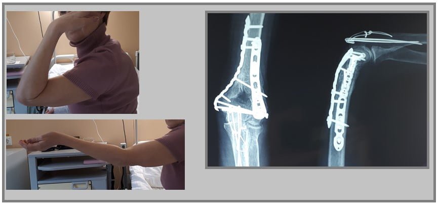 Result of humeral condyle surgery