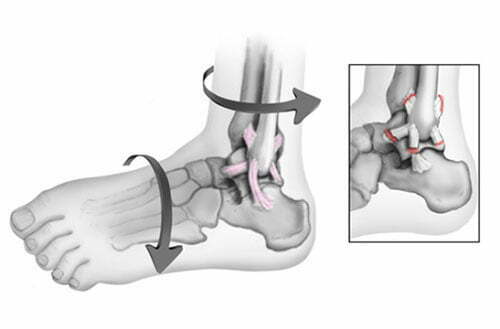 Mechanismus des Bänderrisses