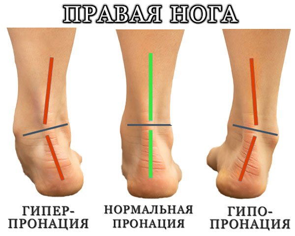 Hyperpronation und Hypopronation