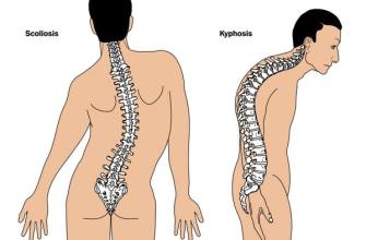 Marfan-Syndrom: Symptome und Behandlung