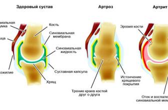 Arthrose