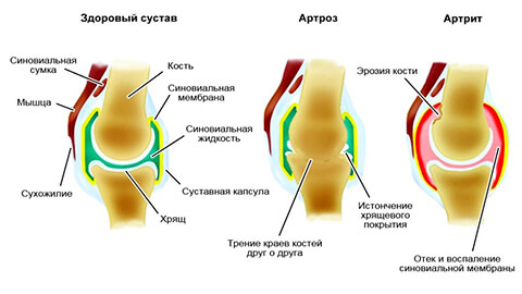 Arthrose