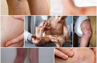 Krampfadern bei Kindern und Heranwachsenden