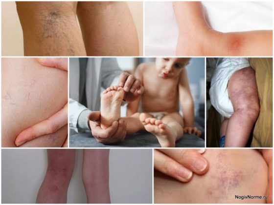 Krampfadern bei Kindern und Heranwachsenden