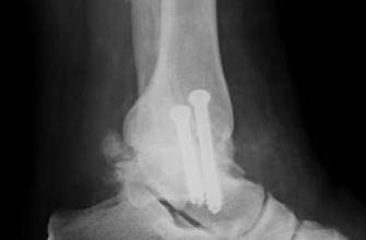 Die Arthrodese hilft, die Schmerzfreiheit und die verlorene Beweglichkeit wiederherzustellen. Bei diesem Verfahren werden spezielle Schrauben und Marknägel verwendet. Diese verankern das Gelenk, bis es vollständig verknöchert ist. © Gelenk-Klinik