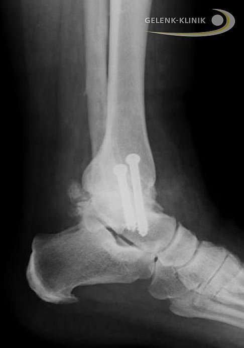 Die Arthrodese hilft, die Schmerzfreiheit und die verlorene Beweglichkeit wiederherzustellen. Bei diesem Verfahren werden spezielle Schrauben und Marknägel verwendet. Diese verankern das Gelenk, bis es vollständig verknöchert ist. © Gelenk-Klinik