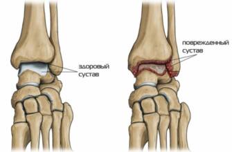 Das Skelett des menschlichen Fußes Arthritis des Fußes.