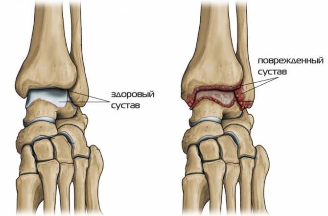 Das Skelett des menschlichen Fußes Arthritis des Fußes.